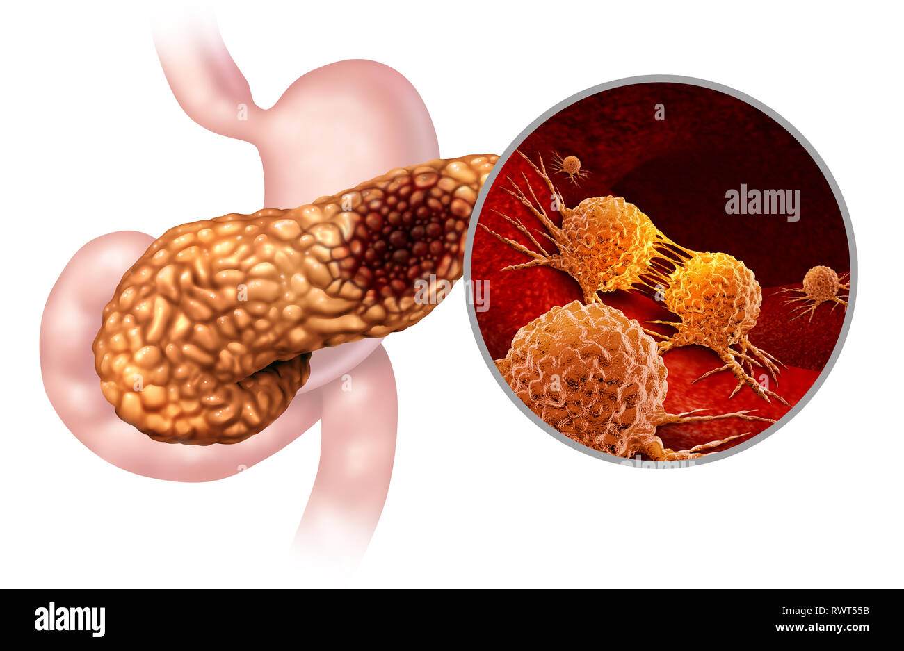 Cancro al pancreas concetto di anatomia e pancreas tumore maligno simbolo come una ghiandola digestiva parte del corpo con un ingrandimento al microscopio. Foto Stock