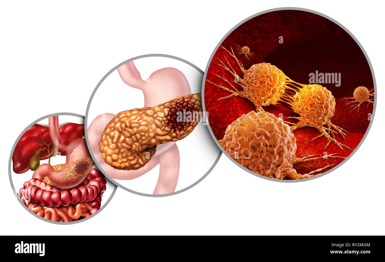 Cancro al pancreas lo schema di anatomia e pancreatici tumore maligno nozione come un medico di simbolo di una ghiandola digestiva della parte di corpo con una microscopica. Foto Stock