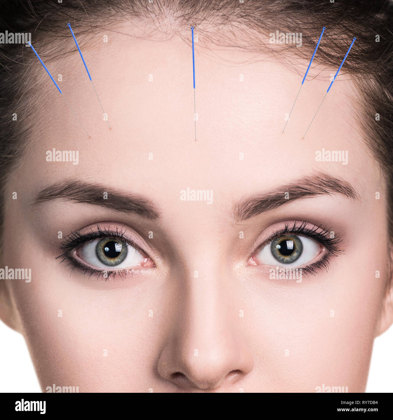 Giovane donna faccia con aghi inseriti. Donna sottoposti a trattamento di agopuntura Foto Stock