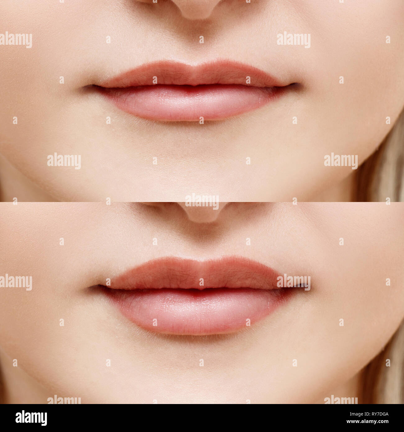 Le labbra della giovane donna prima e dopo l'aumento. Foto Stock