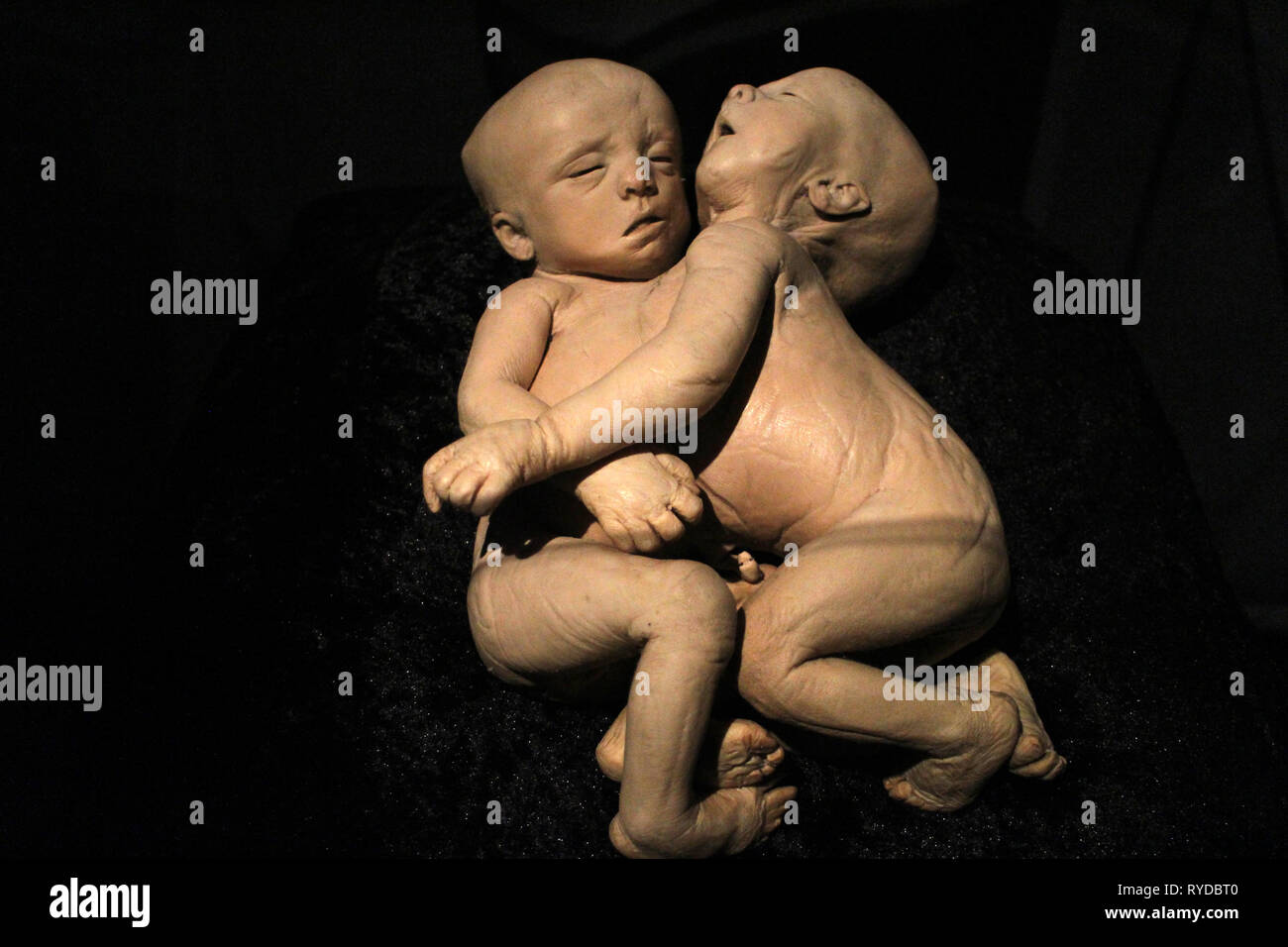 Immagini del corpo mondi plastinates al Menschen Museum di Berlino. Gemelli siamesi Foto Stock