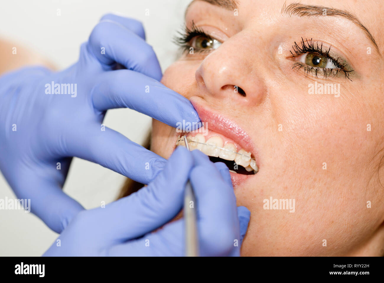 Ortodontista serrando le bretelle. Foto Stock