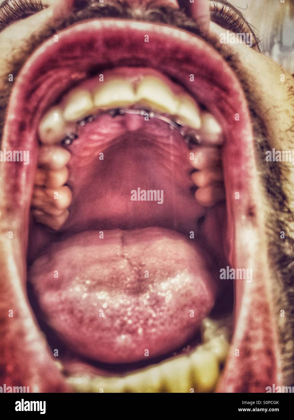 Ottone,ortodontista,Invisalign,denti,lingua rossa,grande lingua,grande bocca,uomo barbuto,denti gialli,dentisti,linea di cromo. Foto Stock