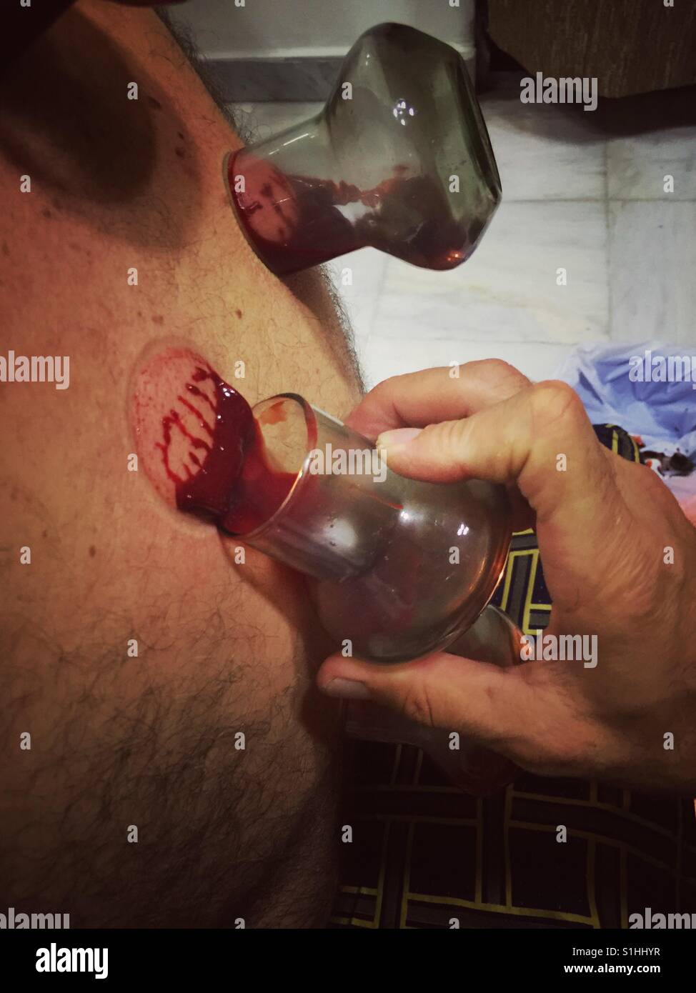 L'uomo facendo coppettazione - Immagine stock catturata con smartphone