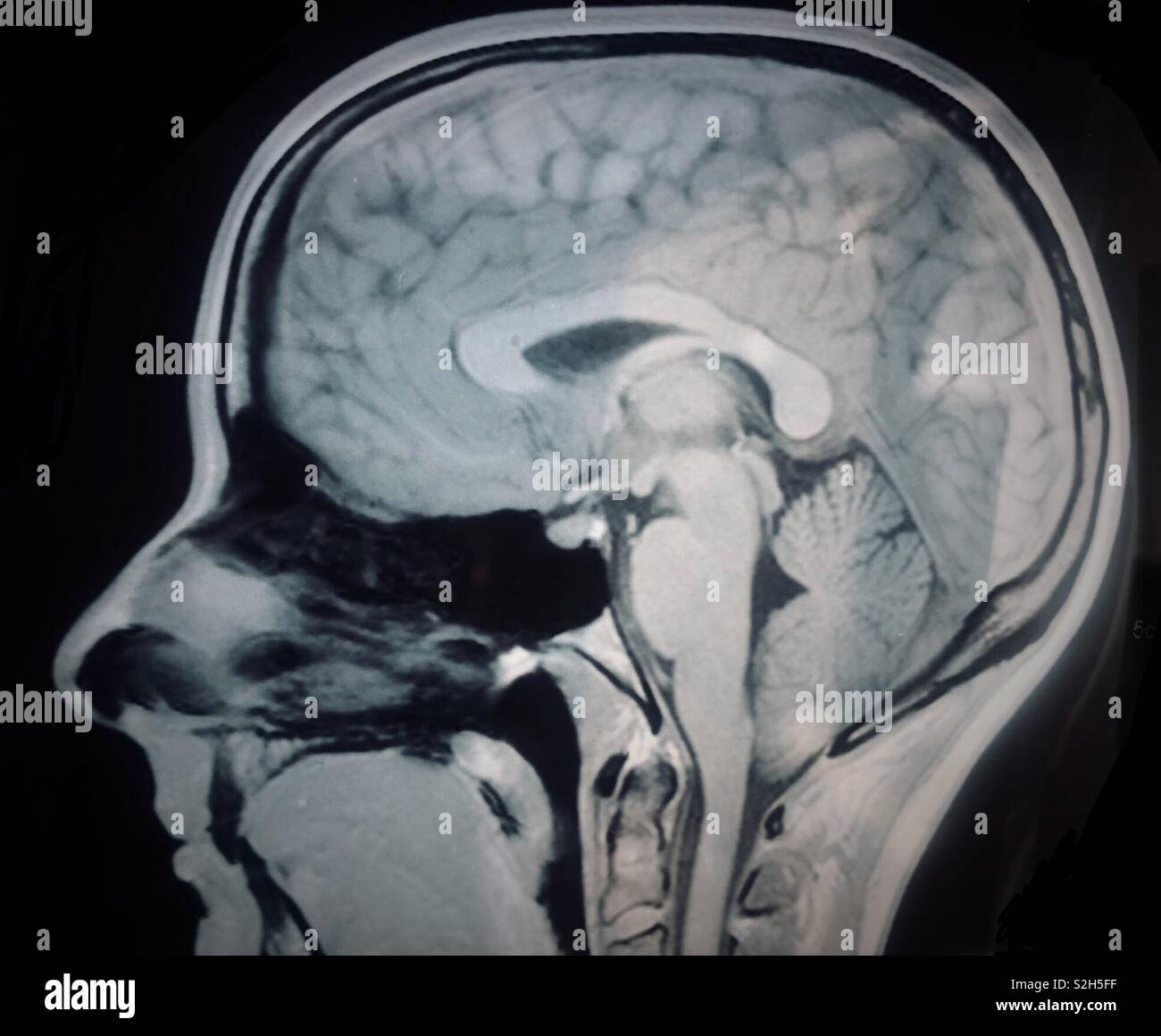 Cervello sagittale MRI scan di sano giovane femmina Foto Stock