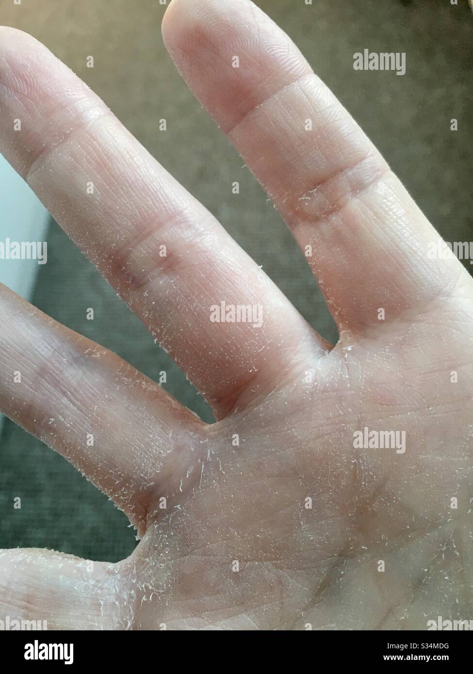 Sindrome Di Raynaud Disturbi Dell Apparato Cardiovascolare Manuali Msd Edizione Professionisti