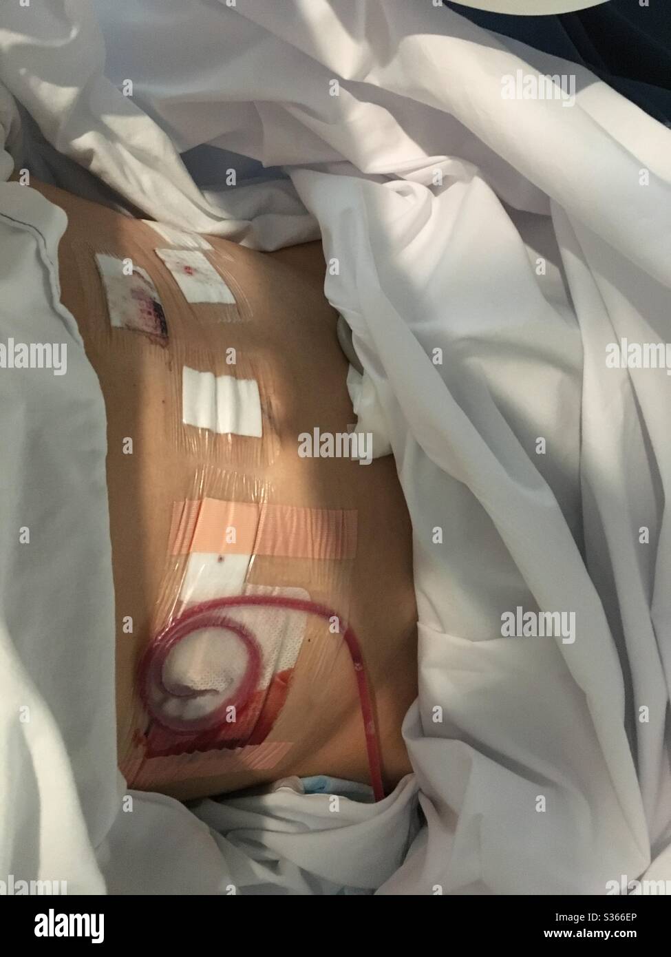 Recupero dopo prostatectomia radicale assistita da robotica. - Immagine stock catturata con smartphone