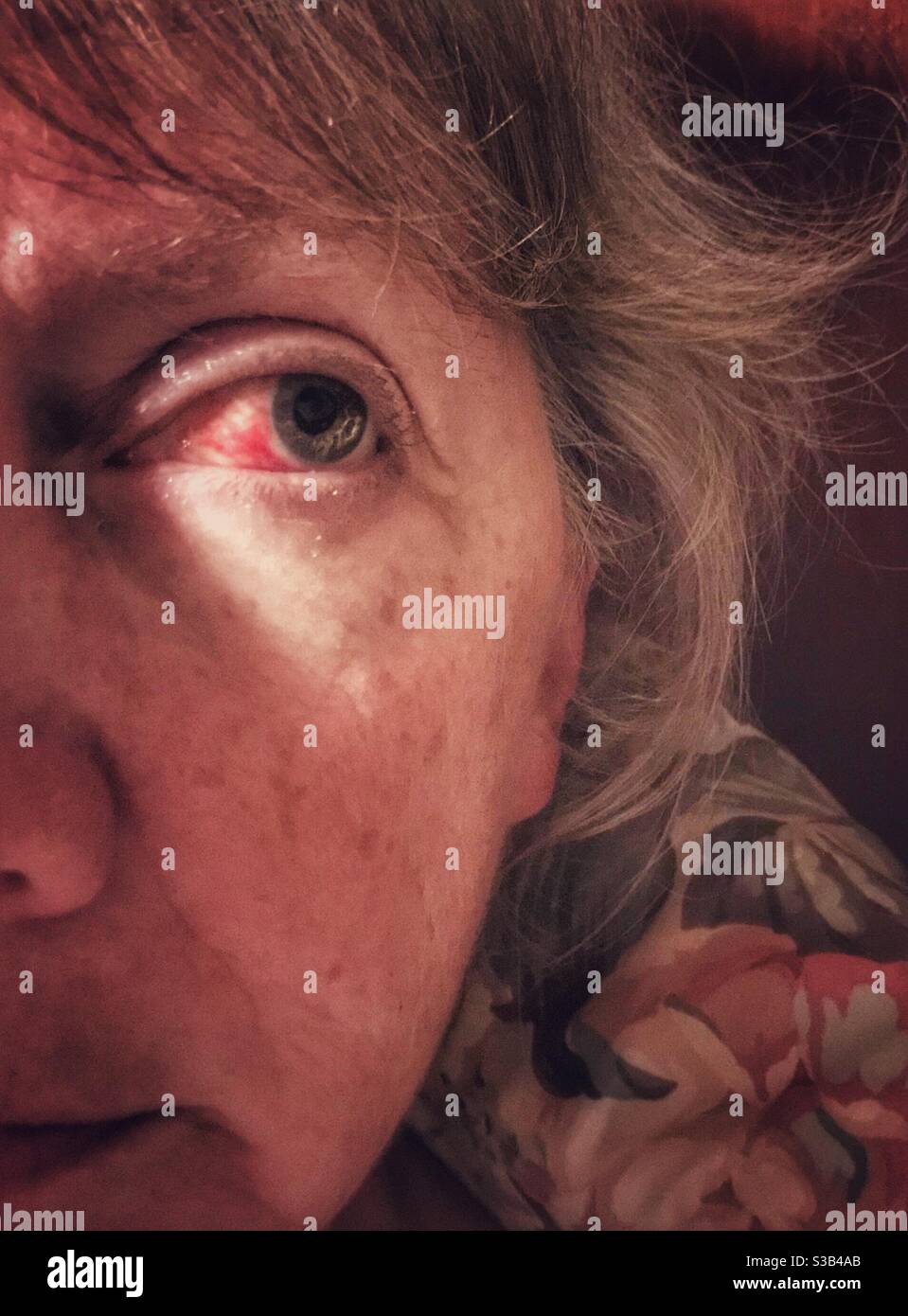 Emorragia subcongiuntivale, o rottura del vaso sanguigno nel bulbo oculare della donna di mezza età - Immagine stock catturata con smartphone