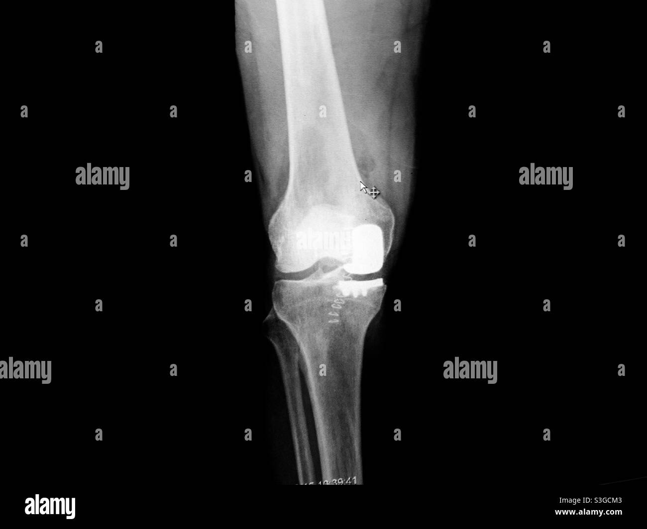 Sostituzione parziale articolazione ginocchio. Artroplastica unicompartimentale del ginocchio. Raggi X presi nella sala di recupero. Graffette ancora in luogo, Ontario, Canada. Per l’artrite, la cisti di Baker, la riparazione dello strappo al menisco. Chirurgia. - Immagine stock catturata con smartphone