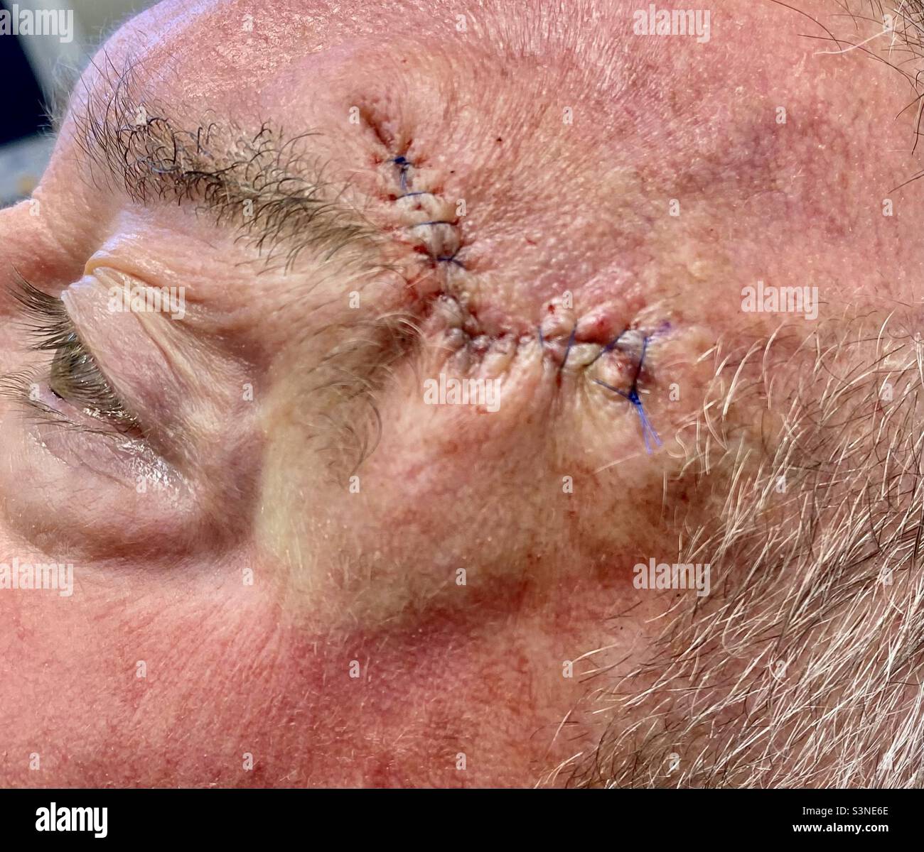 Punti di cancro della pelle sul viso dell’uomo. Foto Stock