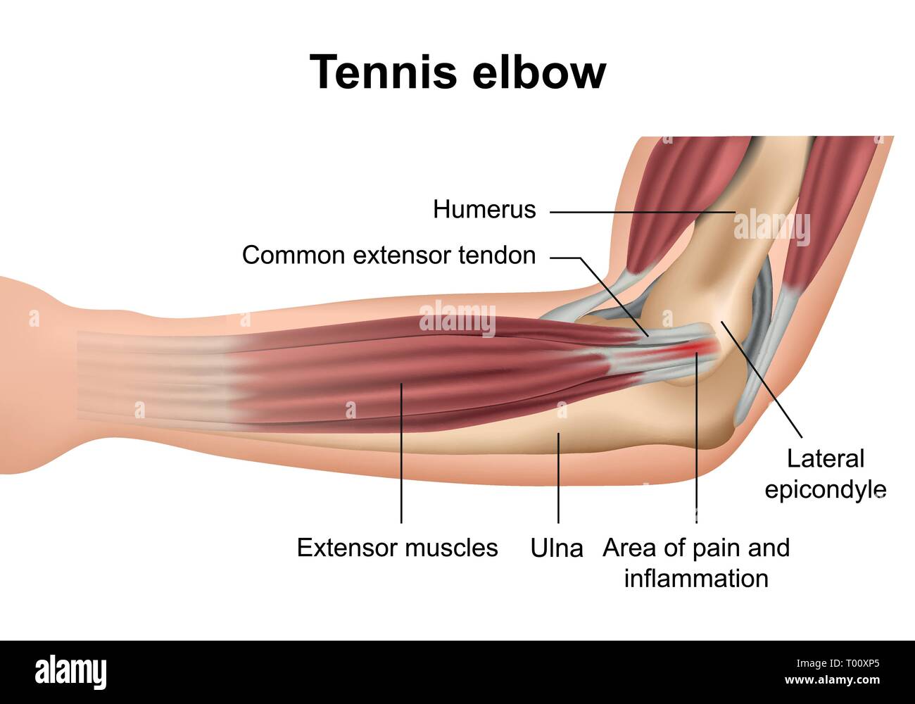 Il gomito del tennista pregiudizio medical illustrazione vettoriale su sfondo bianco Illustrazione Vettoriale