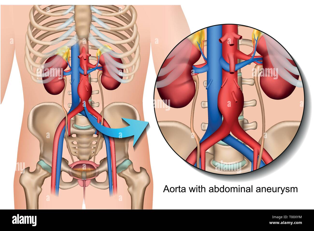 Aortic aneurisma addominale 3d medical illustrazione vettoriale isolati su sfondo bianco Illustrazione Vettoriale