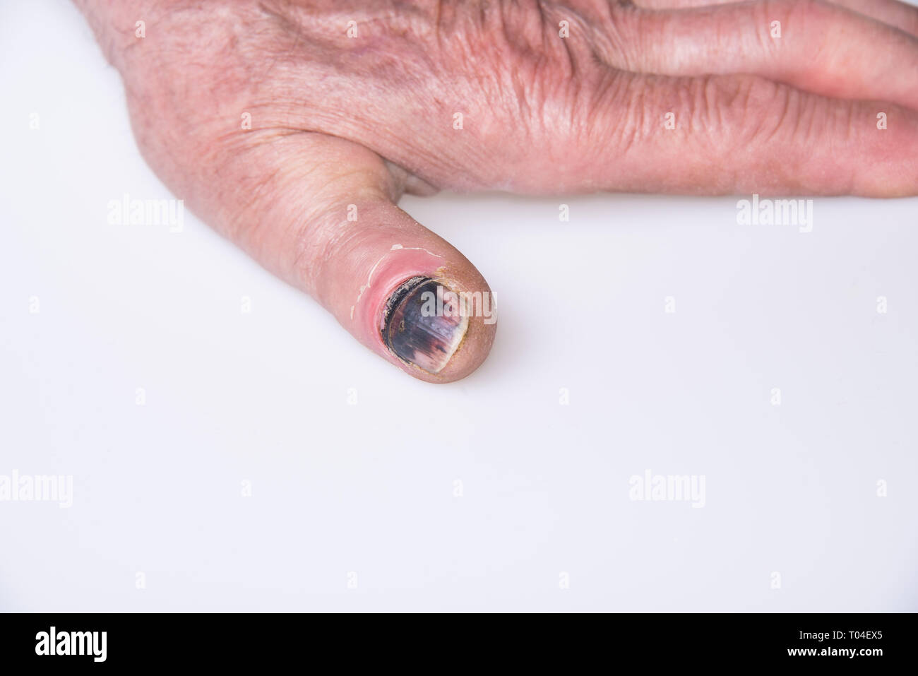 Mano sinistra, nero unghia dal pregiudizio Foto Stock