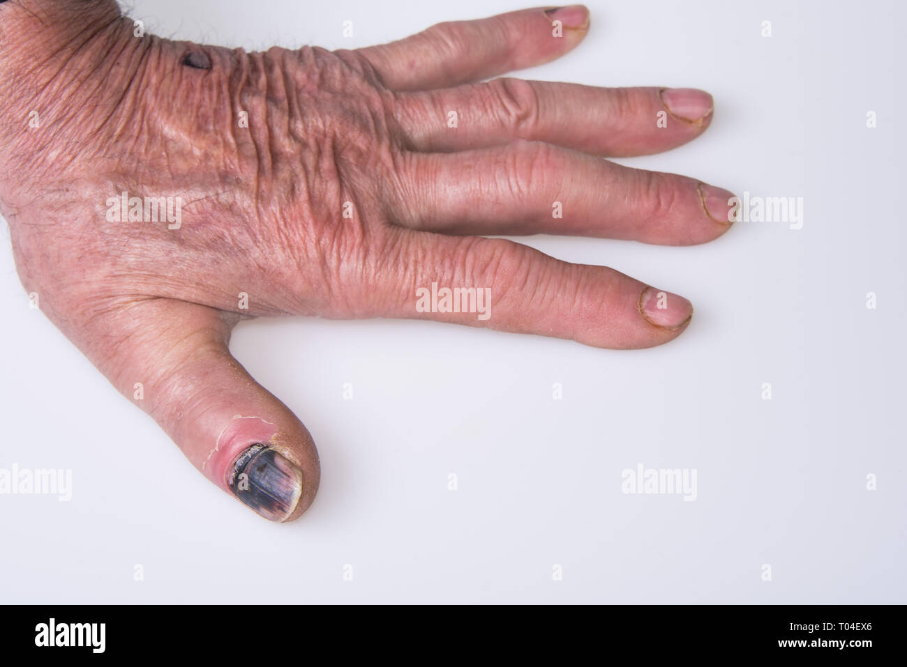 Una mano con un nero pollice unghie su uno sfondo bianco. Foto Stock