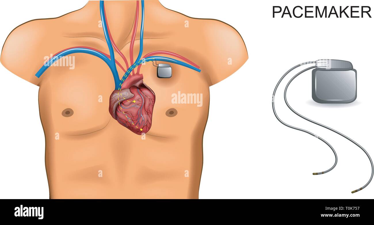Illustrazione vettoriale di cuore e di pacemaker cardiologia. Illustrazione Vettoriale
