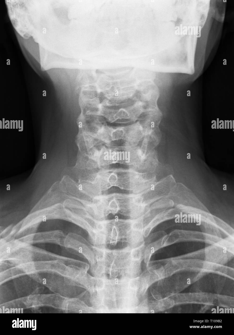 X-ray immagine medica - colonna cervicale e della testa Foto Stock