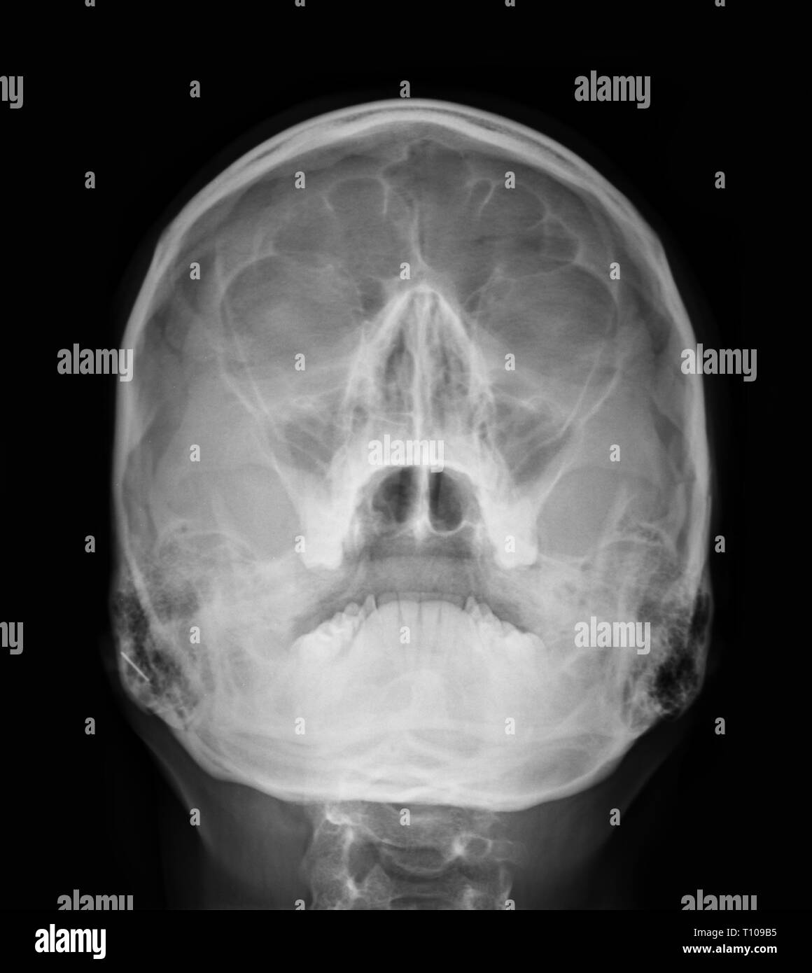 X-ray immagine - scull umano, del sinus Foto Stock