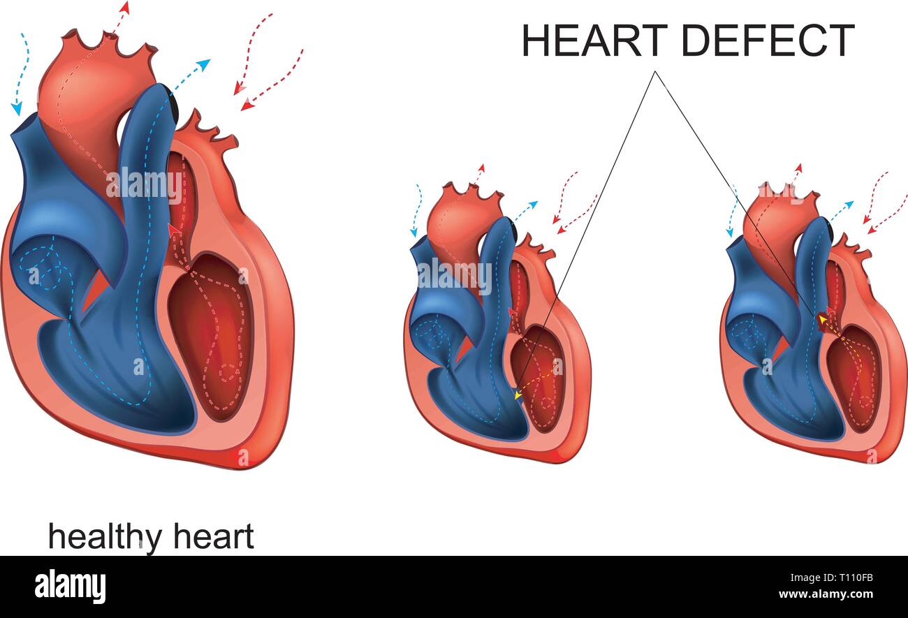 Illustrazione vettoriale di malattia cardiaca, difetto di cardiologia. Illustrazione Vettoriale