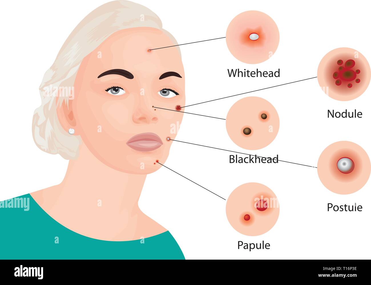 Tipi di acne sul viso un illustrazione vettoriale. La cosmetologia dermocosmesi, trattamento della pelle Illustrazione Vettoriale