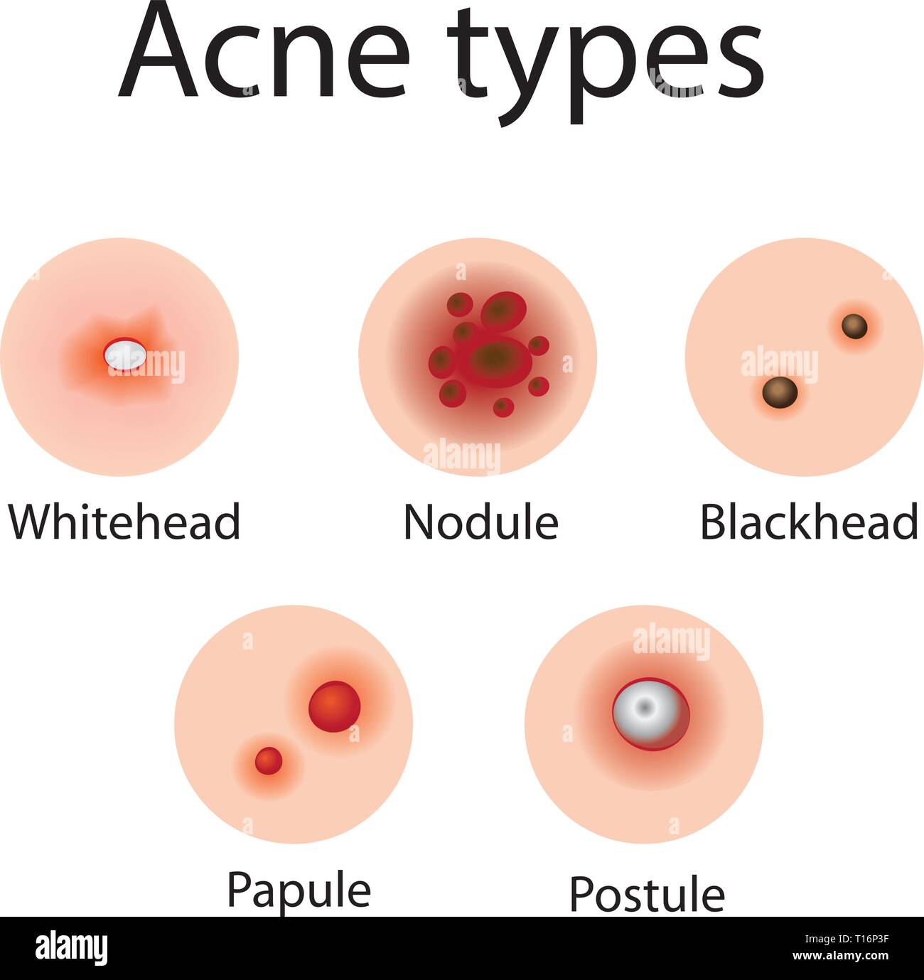 Tipi di acne sul viso un illustrazione vettoriale. La cosmetologia dermocosmesi, trattamento della pelle Illustrazione Vettoriale