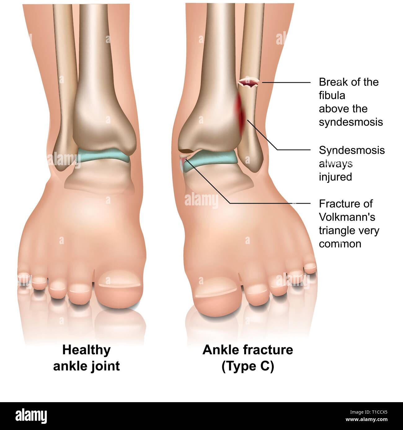 Articolazione della caviglia frattura medical illustrazione vettoriale su sfondo bianco Illustrazione Vettoriale