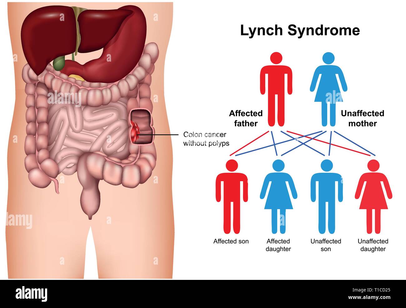 La sindrome di Lynch malattia 3d medical illustrazione vettoriale su sfondo bianco Illustrazione Vettoriale