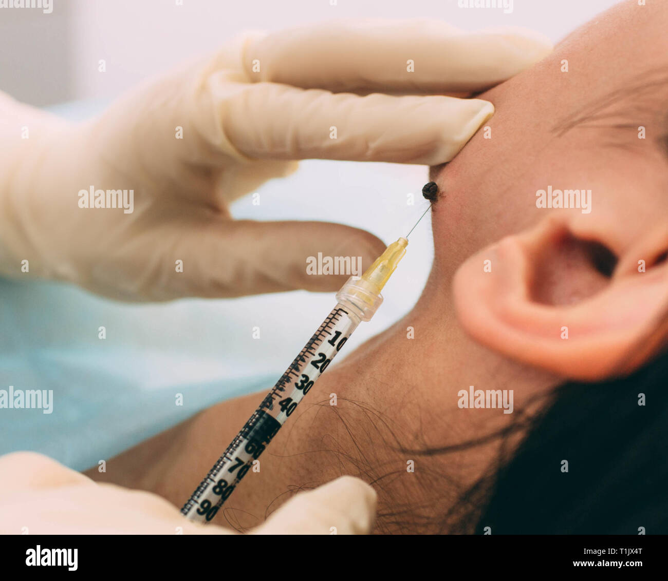Iniezione di anestesia in nevo sul volto femminile, prima onda radio elettrocoagulazione mole rimozione Foto Stock