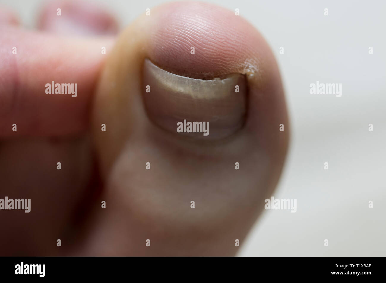 Trauma dell'unghia del piede immagini e fotografie stock ad alta  risoluzione - Alamy