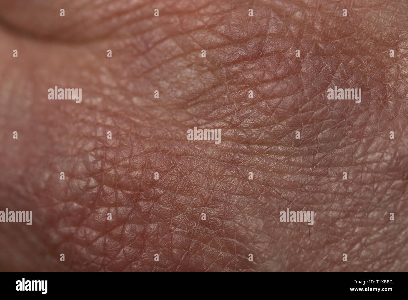 La texture della pelle vicino. Vista al microscopio di asciugare la pelle danneggiata su una mano umana. Foto Stock