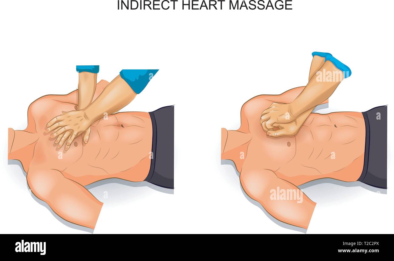 Illustrazione vettoriale di cuore indiretta opzioni di massaggio Illustrazione Vettoriale