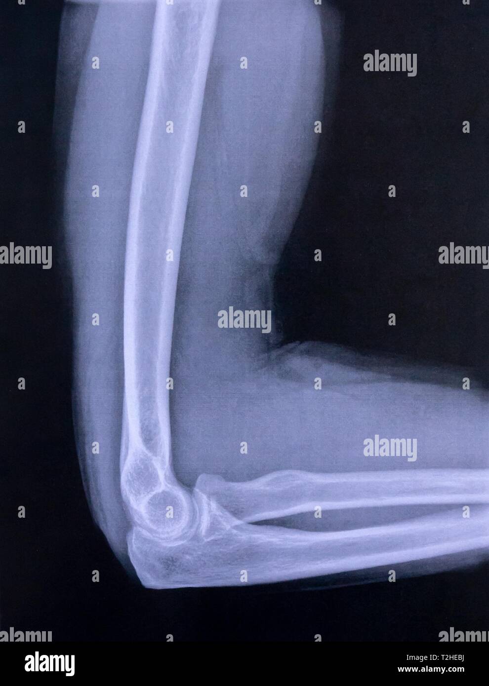 Immagine a raggi X del gomito e la parte superiore del braccio, Germania Foto Stock