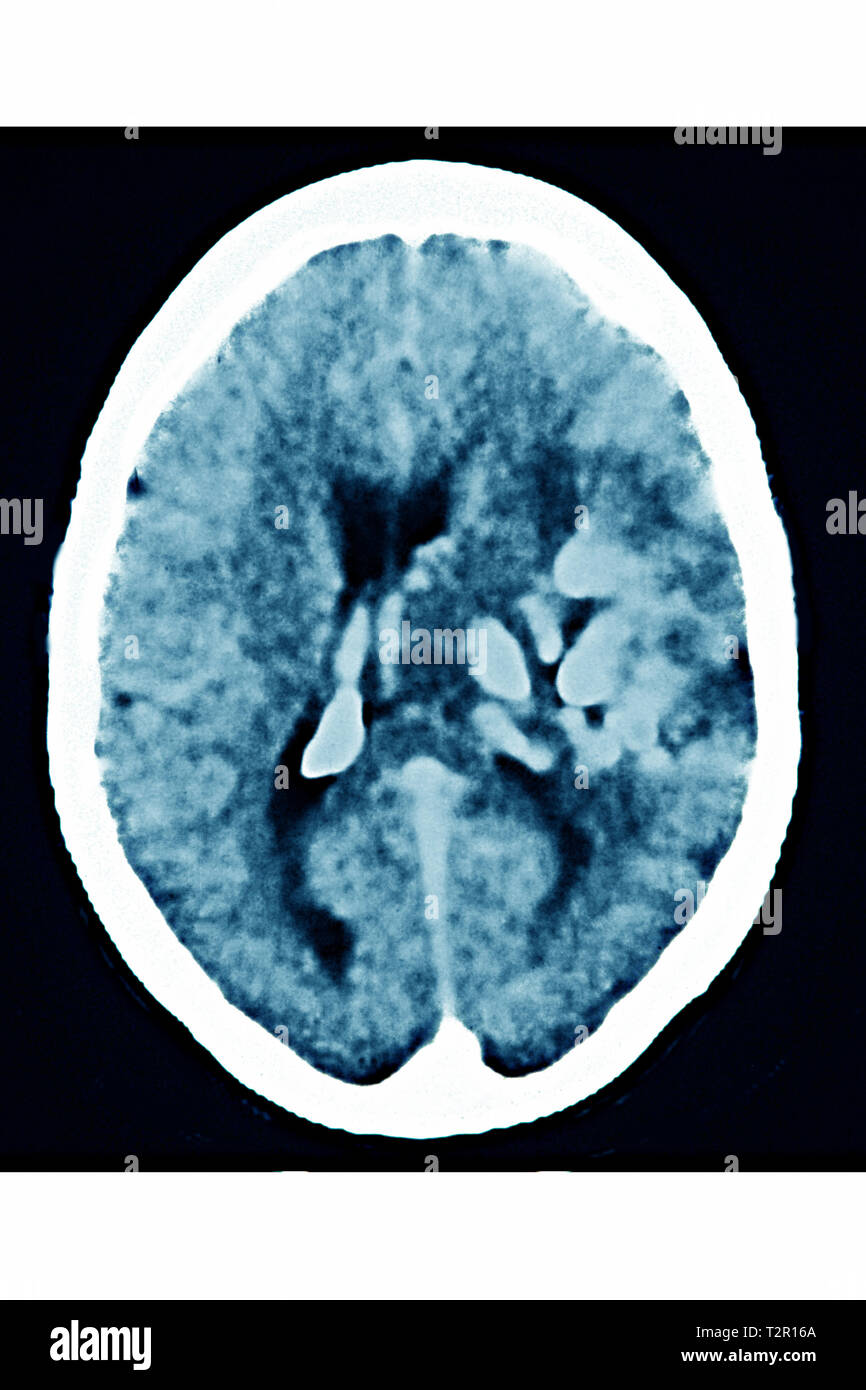 Angioma Foto Stock