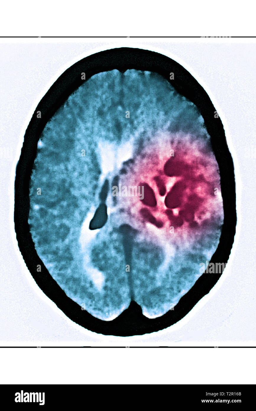 Angioma Foto Stock