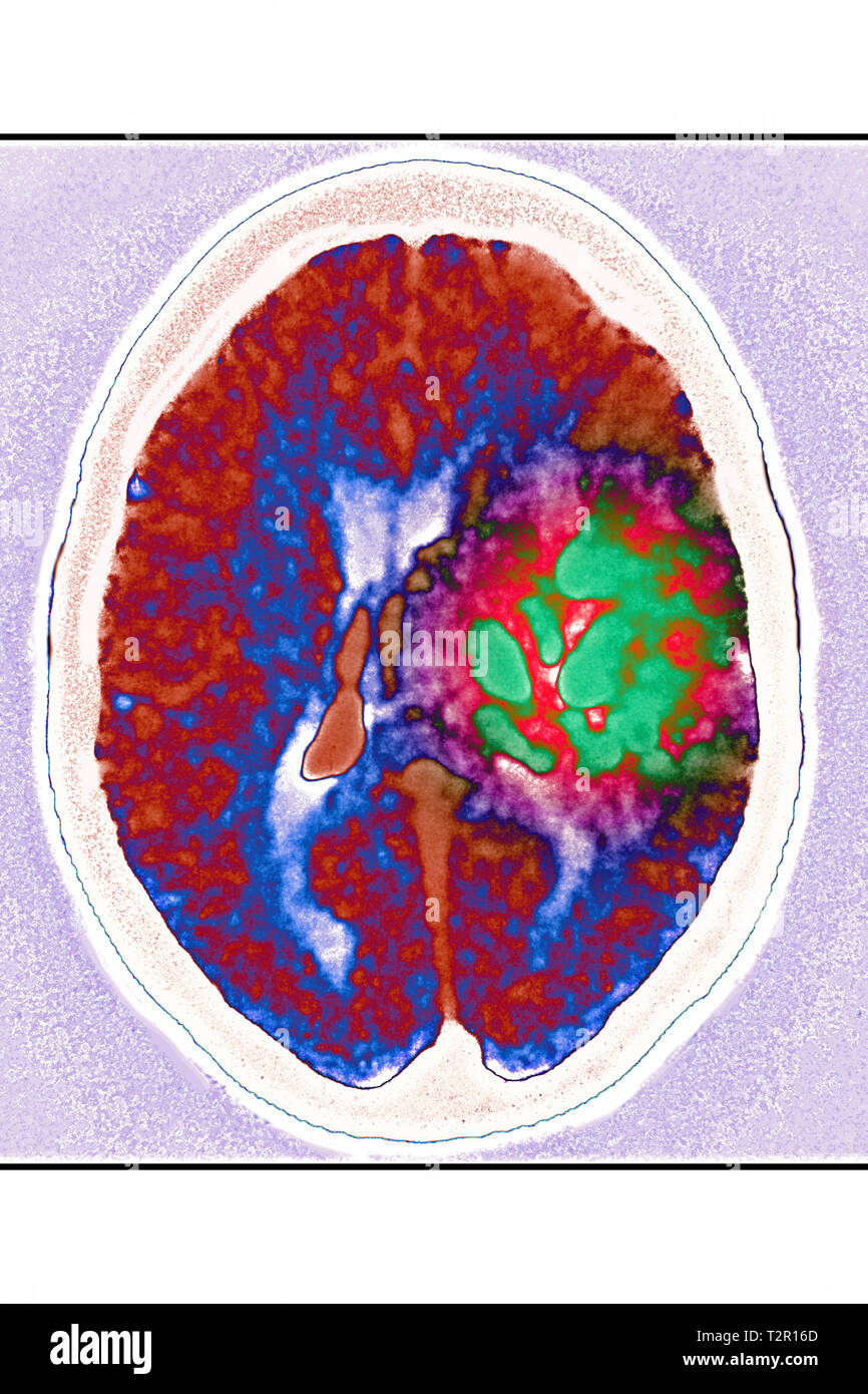 Angioma Foto Stock