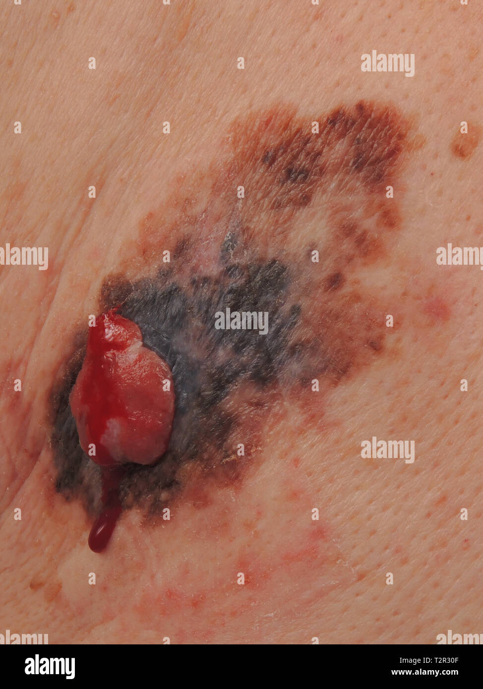 Il melanoma Foto Stock