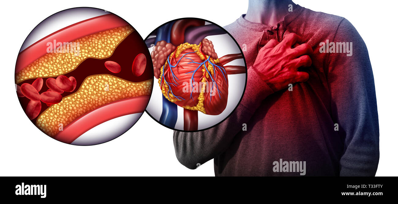 Infarto del miocardio come una persona che soffre di un attacco di cuore a causa di intasamento di arteria coronarica come cardiologia simbolo di emergenza con 3D'illustrazione. Foto Stock