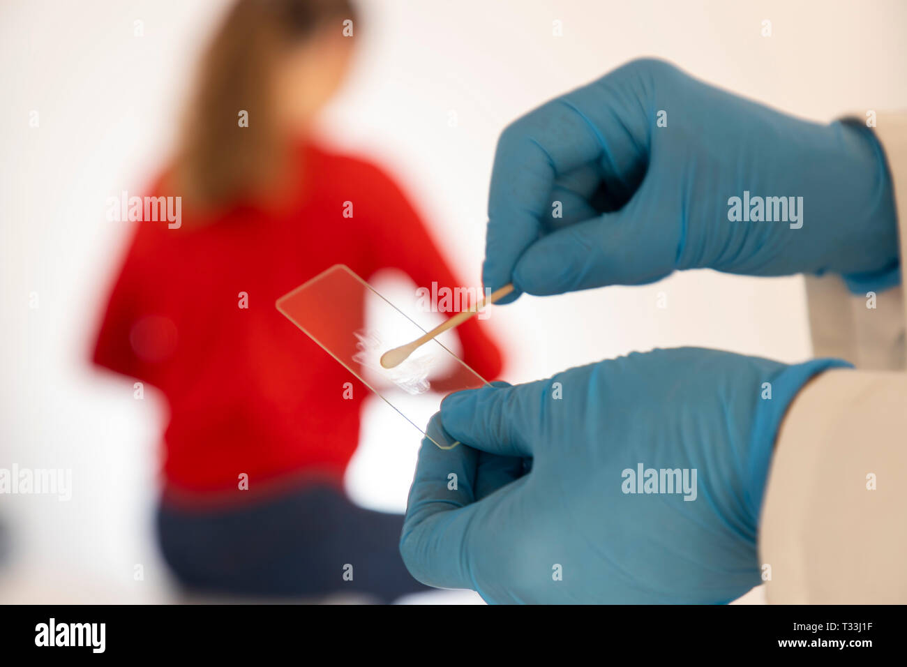 Il cancro cervicale, carcinoma cervicale, cospargere dopo un esame del canale cervicale, lo striscio viene esaminato microscopicamente, per cambiamenti cellulari, PAP t Foto Stock