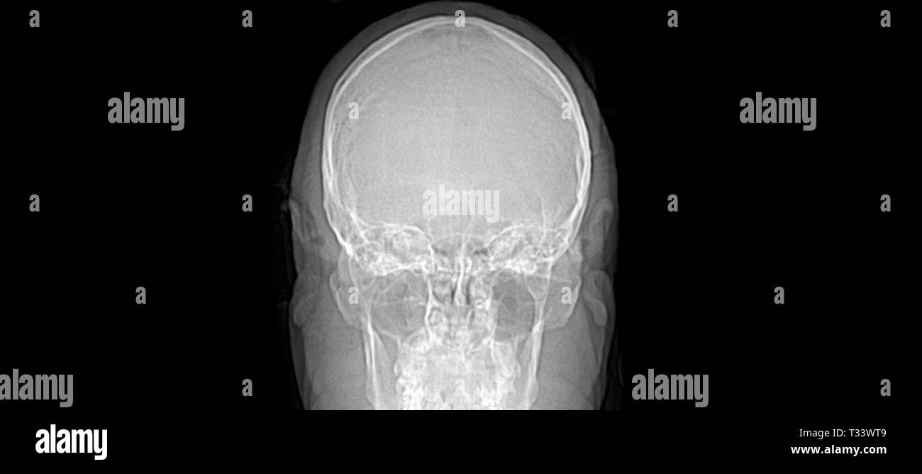 Immagini a risonanza magnetica (MRI) testa cervello sagittale umana / scansione TC Foto Stock