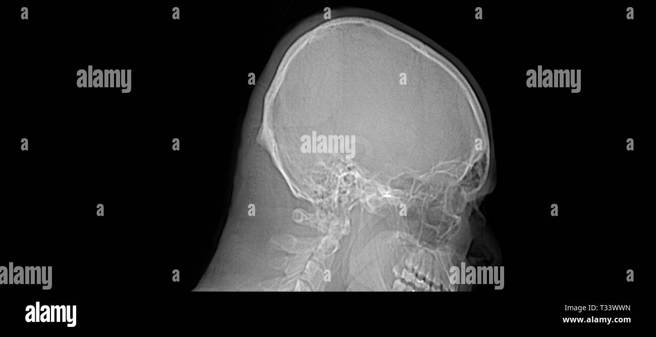 Immagini a risonanza magnetica (MRI) testa cervello sagittale umana / scansione TC Foto Stock