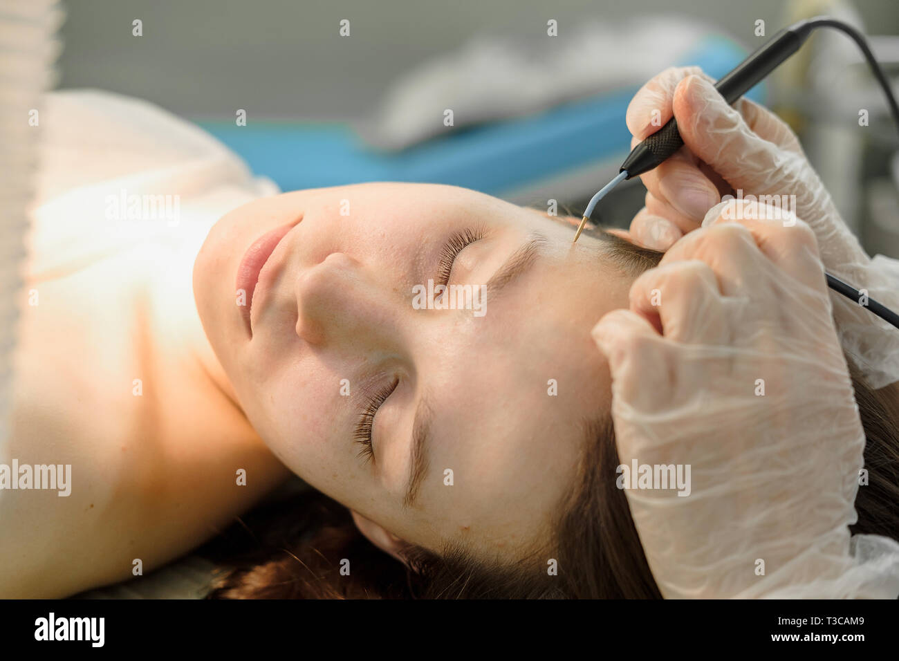 Trattamento medico la rimozione di birthmark femmina dal viso del paziente. Femmina dermatologo chirurgo utilizzando professional elettrocauterizzazione per la rimozione di mole. R Foto Stock