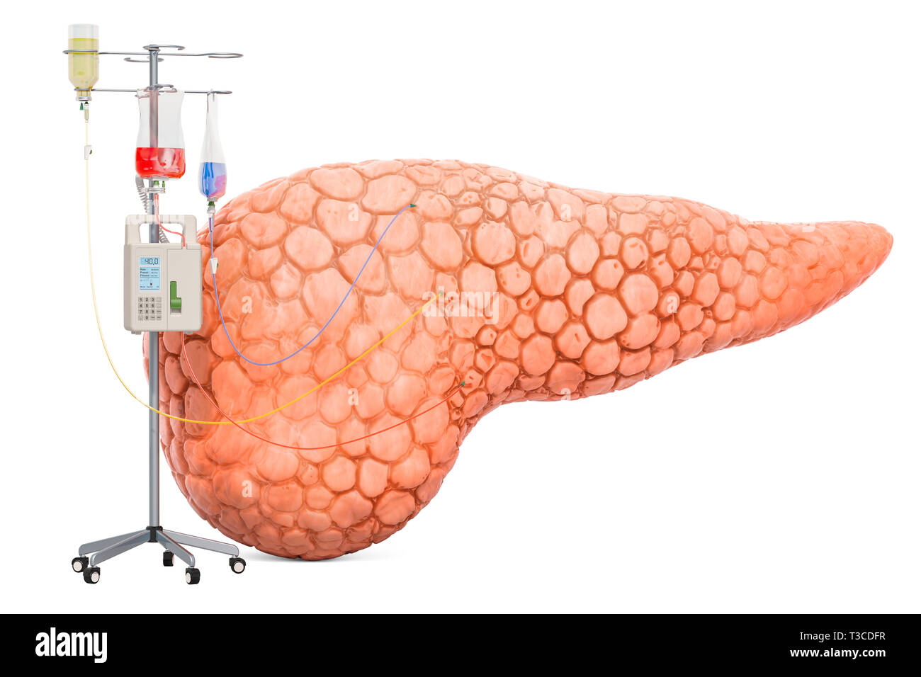 Terapia endovenosa con sistema pancreatico. Trattamento di malattie pancreatiche concetto, 3D rendering isolati su sfondo bianco Foto Stock