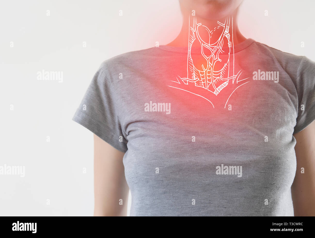 Gola femmina con evidenziato il dolore / infezione influenzale Foto Stock