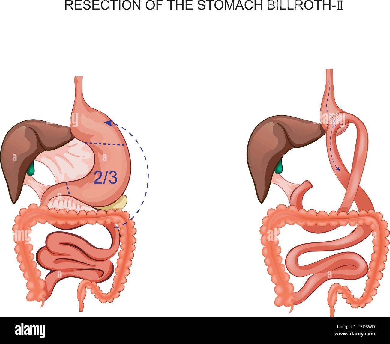 Illustrazione vettoriale di schema della resezione dello stomaco Billroth 2 Illustrazione Vettoriale