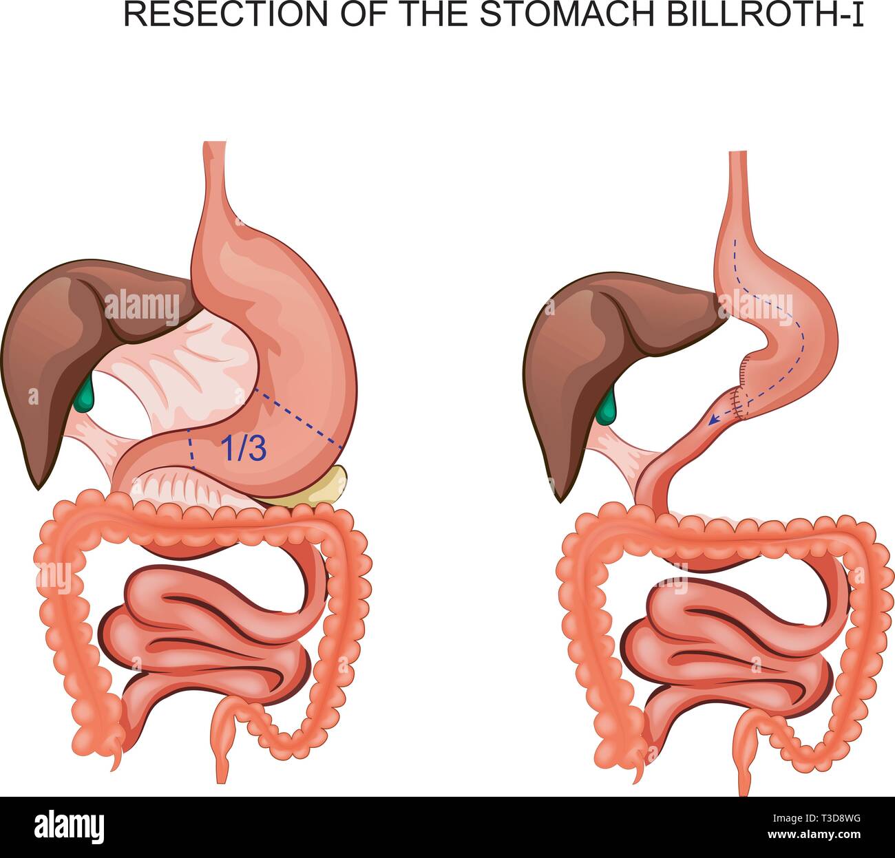 Illustrazione vettoriale di schema della resezione dello stomaco Billroth 1 Illustrazione Vettoriale