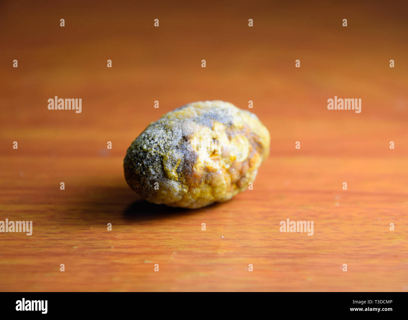 Grandi gallstone, cistifellea pietre. Il risultato dei calcoli biliari. Un calcolo di composizione eterogenea su uno sfondo marrone Foto Stock