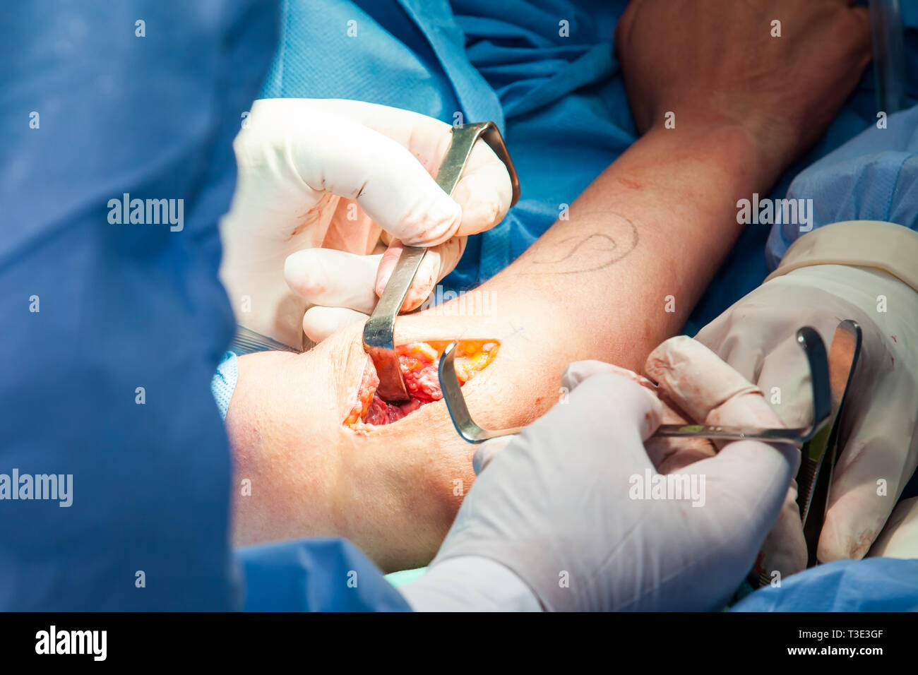 Gruppo di chirurghi ortopedici di eseguire l'intervento chirurgico su un braccio del paziente Foto Stock
