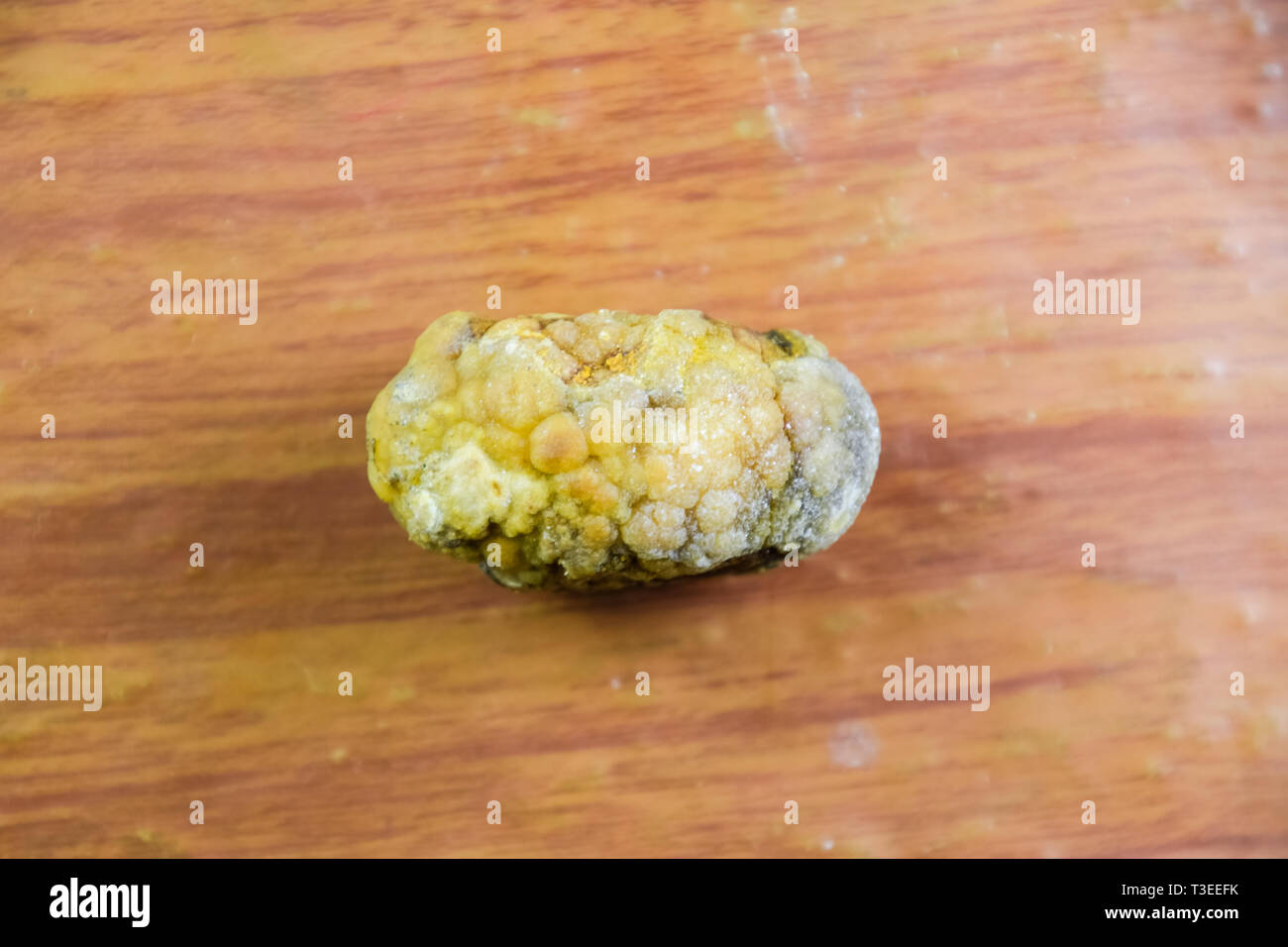 Grandi gallstone, cistifellea pietre. Il risultato dei calcoli biliari. Un calcolo di composizione eterogenea su uno sfondo marrone Foto Stock