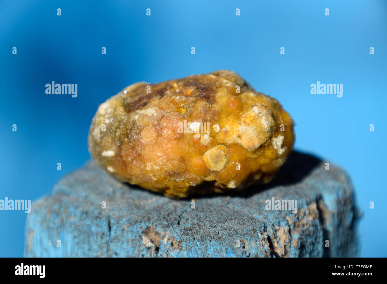 La cistifellea pietre. Il risultato dei calcoli biliari. Calcolo della composizione eterogenea Foto Stock