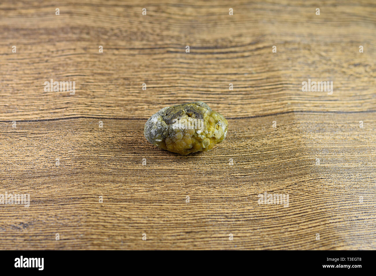 Grandi gallstone, cistifellea pietre. Il risultato dei calcoli biliari. Calcolo della composizione eterogenea Foto Stock
