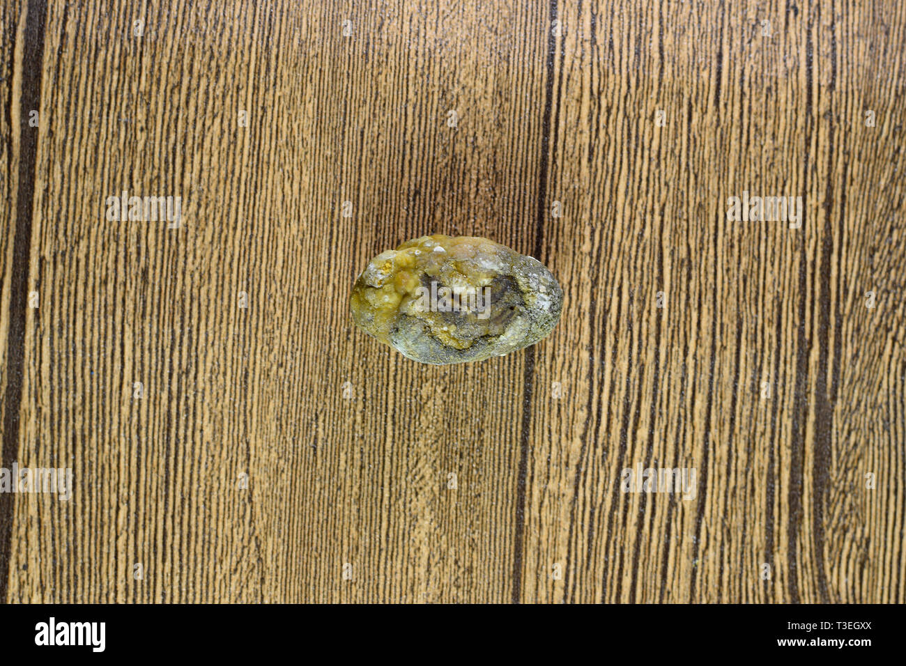 Grandi gallstone, cistifellea pietre. Il risultato dei calcoli biliari. Calcolo della composizione eterogenea Foto Stock